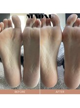 マオヌー(MAONU)/韓国式足裏角質ケア　症例写真