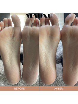 マオヌー(MAONU)/韓国式足裏角質ケア　症例写真