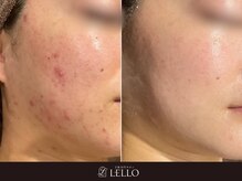 【生理前の肌荒れ】無理のない月1ケアでトラブル知らずのお肌に