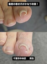 巻き爪じゅん 千葉駅前店/巻き爪の痛みが改善しました！