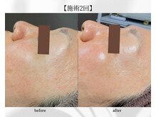 アン ビューティー(ann beauty)/施術2回【症例写真】40代