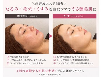 山参の写真/ほうれい線・たるみ改善で若見え小顔へ