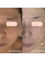 ゼアー(THERE FY.) 諦めていたシワもふっくら若見え艶肌へ♪ラミネーションピール