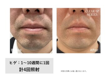 コルギと小顔矯正サロン ウンジョルノ フェリーチェ(un giorno felice)の写真/【完全個室×都度払いOK】毎朝のヒゲ剃り卒業！敏感肌の方も濃く太い毛もしっかりケア♪[ひげ脱毛1回￥5000]