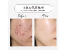 スキンベイビー 池袋店(Skin Baby)の雰囲気(ヒト幹細胞ハーブピーリングで最強肌質改善!美肌へ導きます)
