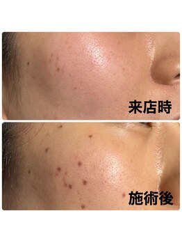 リーストア(Re:Store)/シミケア