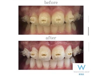 ホワイトニングショップ 新潟店/ホワイトニングビフォーアフター