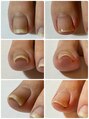 ネイルカフェ ナナ(nailcafe'nana)&nbsp;巻き爪矯正