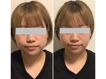 ペリー(PELLY)/小顔矯正