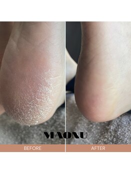 マオヌー(MAONU)/韓国式足裏角質ケア　症例写真