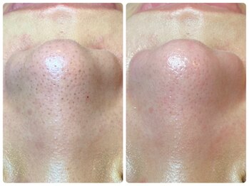 ピエル 北千住店(PIEL)/ツルツル毛穴レス肌