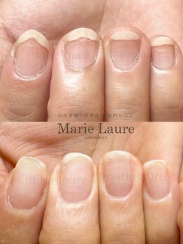 マリーロール 淀屋橋本店(Marie Laure)/深爪矯正/自爪育成/ネイルケア