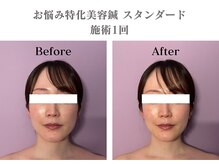 シー バイ カリスタ 表参道店(C by CALISTA)/美容鍼60分 施術効果