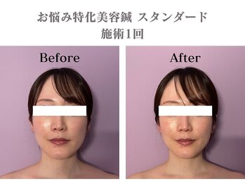 シー バイ カリスタ 表参道店(C by CALISTA)/美容鍼60分 施術効果