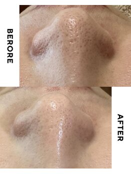 フェリノ(FERINO)/毛穴の種類によって