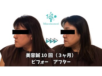 ミノリノモリ(Minorinomori)/美容鍼10回ビフォーアフター