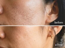 ソレイユ(Soleil)/毛穴の開き・黒ずみ