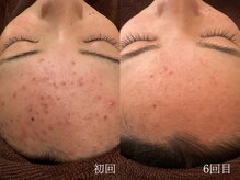 ウォーム(warm)/ニキビケア/肌荒れ/ニキビ肌