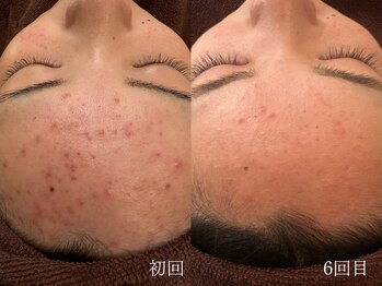 ウォーム(warm)/ニキビケア/肌荒れ/ニキビ肌