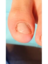 フットケアサロン ラビフット(Rabbi foot)/欠けた爪はすぐに対処しましょう