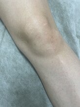 ナノハナ/鹿沼市の全身脱毛のナノハナ