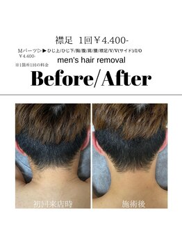 アイラッシュサロン ドール(Doll)/【メンズ】襟足脱毛