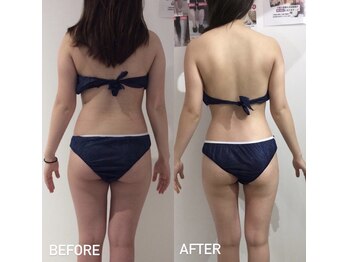 エスグレース 梅田店(S.grace)/痩身施術ダイエット！