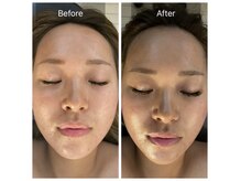 皮膚先生の雰囲気（大人気の毛穴洗浄でお肌つるつるに♪Before→After）