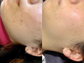 エモーショナル 姫路(Emotional)/ハーブピーリングで跡ケア