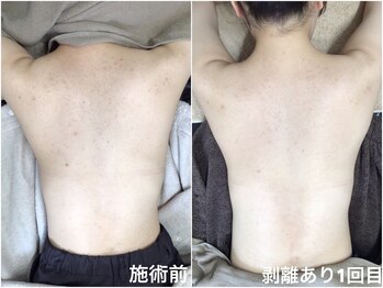 エミルカ(EMILUCA)/背中の剥離ハーブピーリング