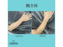 アクト クロ(ACT curro)/【腕全体】脱毛施術例