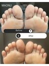 韓国式足裏角質ケア 症例写真