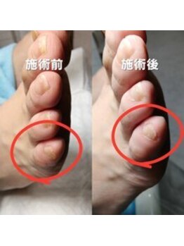 【たこ・うおのめ】リラク/足裏