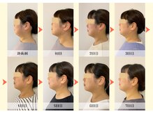 チル(Chill.)/小顔リフト整顔 3