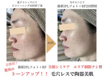 エソア(esoa)/他店でレーザートーニング10回