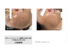 サロン ルアナ(salon luana)/光フェイシャル　before→after
