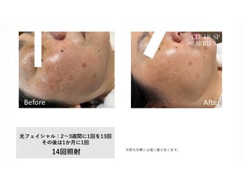 サロン ルアナ(salon luana)/光フェイシャル　before→after