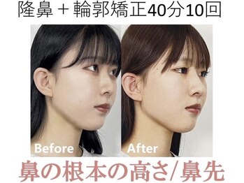 ラプリ 梅田店(Raplit)/隆鼻＋輪郭矯正40分10回