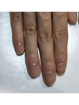 ティアラネイル 宇都宮/深爪矯正