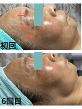 ラ ピュール(LA PUR)/しみケア艶肌プレミアム