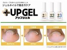 巻き爪ケア/フットケア