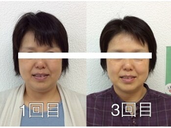 ビューティスタジオＫ/小顔矯正ビフォーアフター