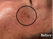 ダイヤモンド リーエンダ(Diamond leende)/クレイハーブピーリング