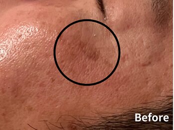 ダイヤモンド リーエンダ(Diamond leende)/クレイハーブピーリング