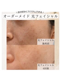 アエ(ae)/オーダーメイド光フェイシャル♪