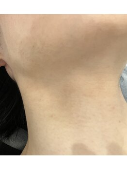 ムーンストーン(Moonstone)/メンズヒゲ脱毛あご下までキレイ