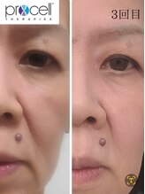 温(on)/プロセルセラピーズ肌質改善