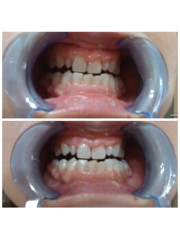 おうちサロン しゅろ/美容セルフホワイトニング　1回