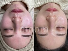 ムーム なんば店(moom)/セルマン化粧品とピーリングset