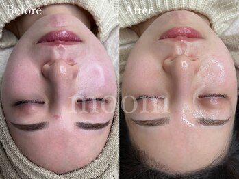 ムーム なんば店(moom)/セルマン化粧品とピーリングset